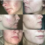 Blemish-Control-Cleanser-for-mild-acne-prone-skin-min