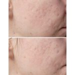 Blemish-Control-Cleanser-for-mild-acne-prone-skin-min